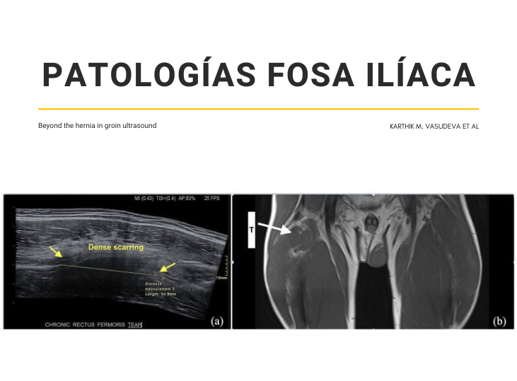 patologias-fosa-iliaca-y-ecografia-parte-5